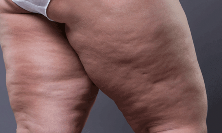 Lipedema